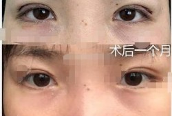 郑州双眼皮厂爆料视频,揭秘整形行业的真实面貌