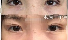 郑州双眼皮厂爆料视频,揭秘整形行业的真实面貌