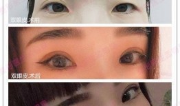 郑州双眼皮厂爆料视频,揭秘整形行业的真实面貌